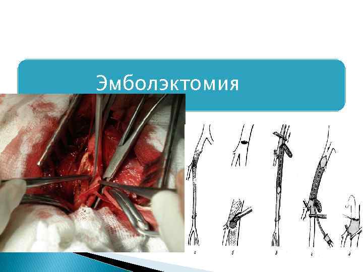 Эмболэктомия 