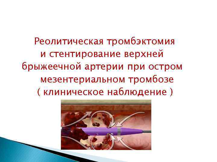 Реолитическая тромбэктомия и стентирование верхней брыжеечной артерии при остром мезентериальном тромбозе ( клиническое наблюдение