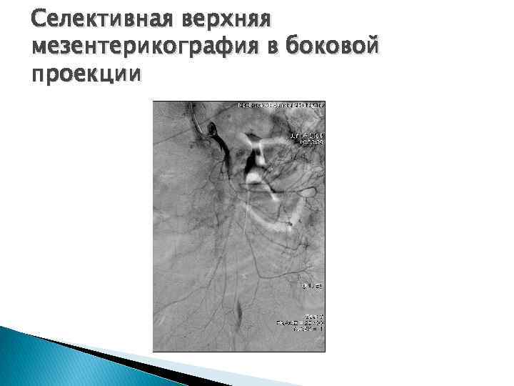 Селективная верхняя мезентерикография в боковой проекции 