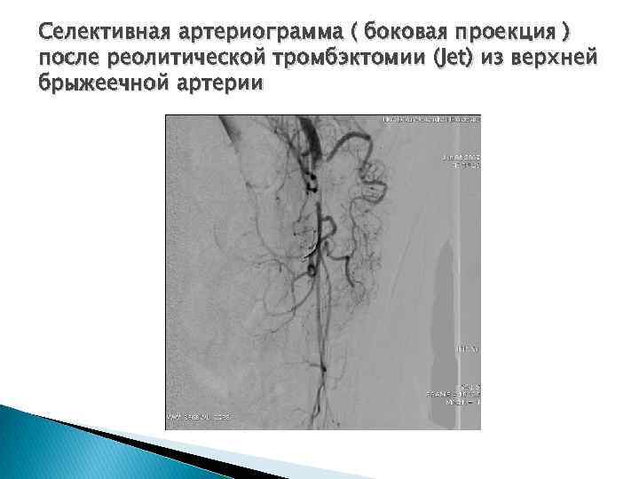 Селективная артериограмма ( боковая проекция ) после реолитической тромбэктомии (Jet) из верхней брыжеечной артерии