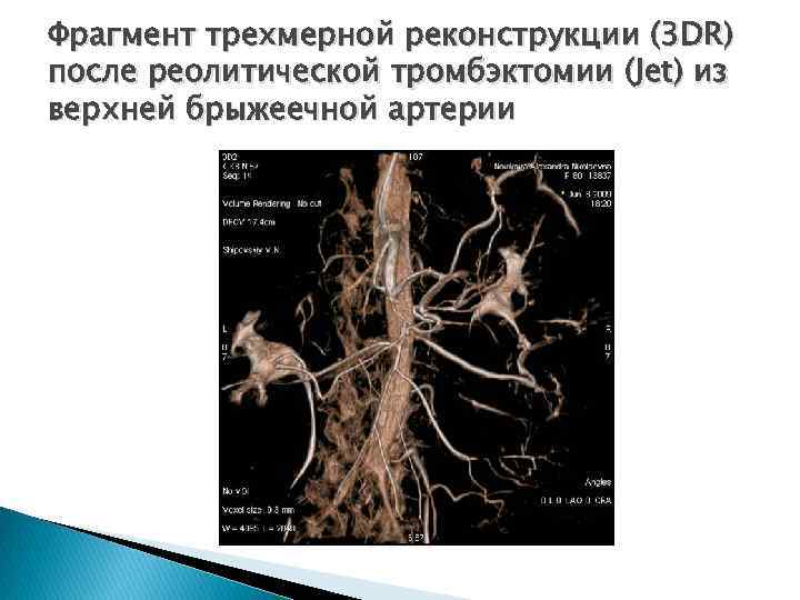 Фрагмент трехмерной реконструкции (3 DR) после реолитической тромбэктомии (Jet) из верхней брыжеечной артерии 