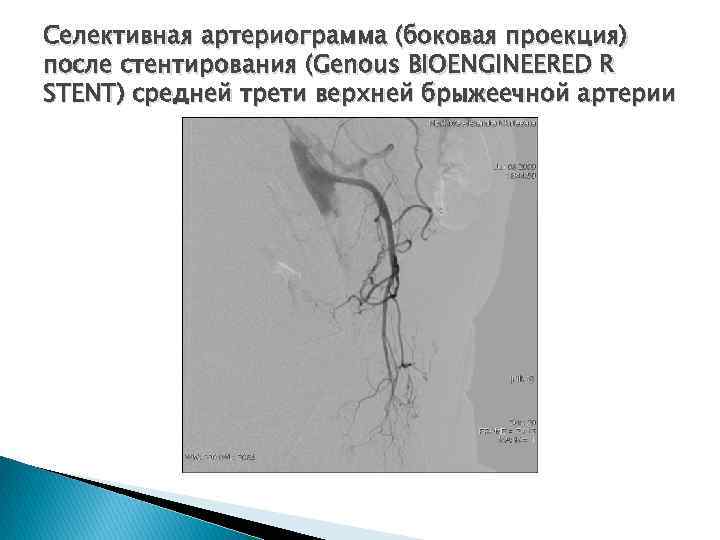 Селективная артериограмма (боковая проекция) после стентирования (Genous BIOENGINEERED R STENT) средней трети верхней брыжеечной