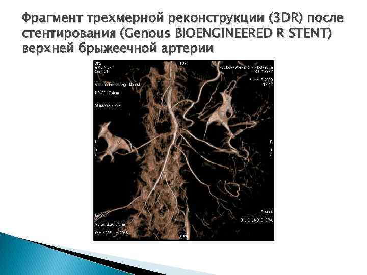 Фрагмент трехмерной реконструкции (3 DR) после стентирования (Genous BIOENGINEERED R STENT) верхней брыжеечной артерии