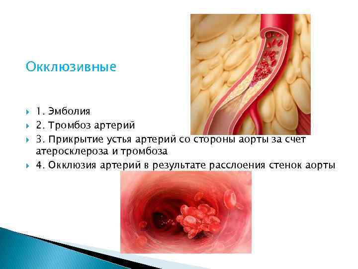Окклюзивные 1. Эмболия 2. Тромбоз артерий 3. Прикрытие устья артерий со стороны аорты за