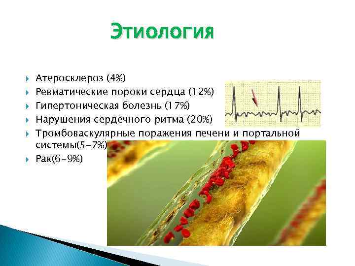 Этиология Атеросклероз (4%) Ревматические пороки сердца (12%) Гипертоническая болезнь (17%) Нарушения сердечного ритма (20%)
