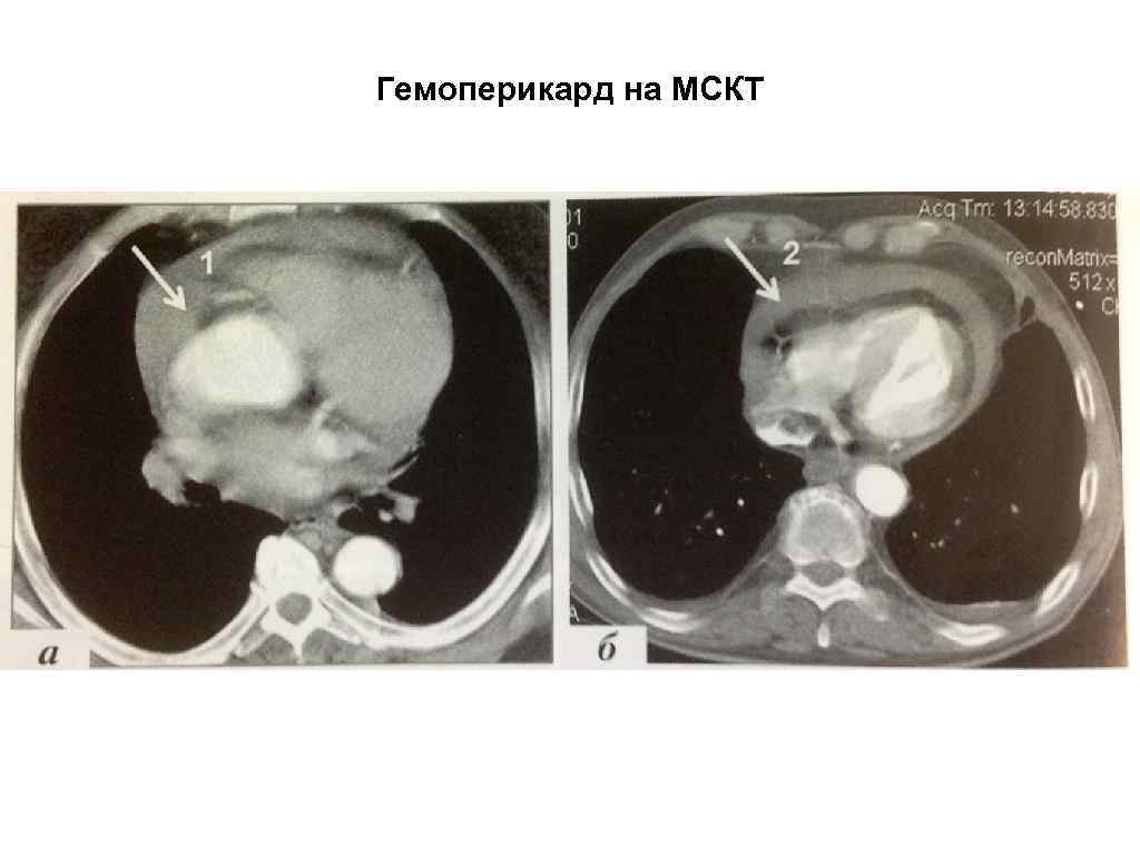 Гемоперикард на МСКТ 