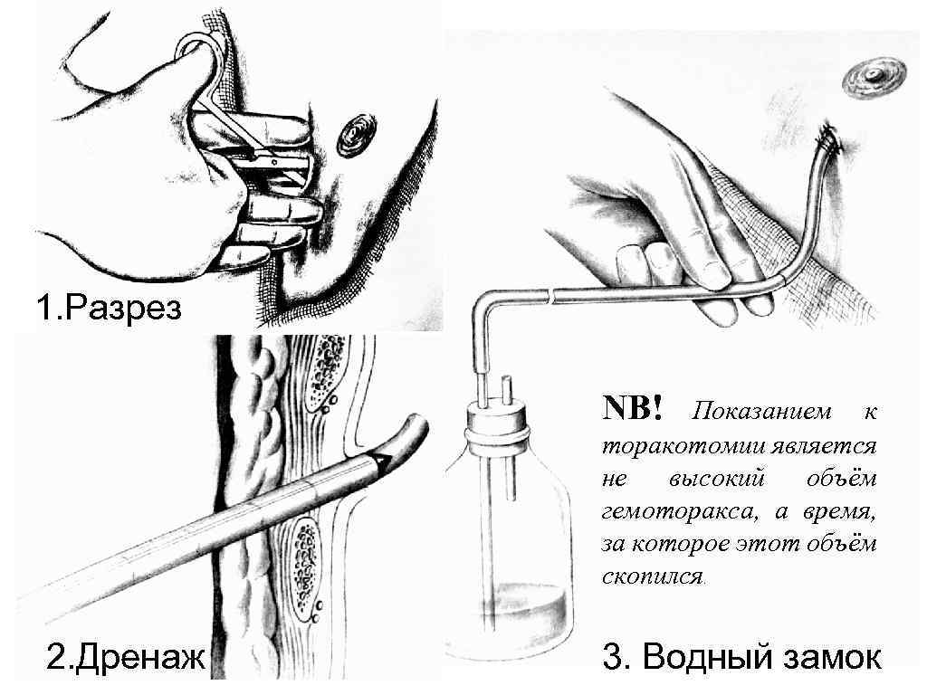 1. Разрез NB! Показанием к торакотомии является не высокий объём гемоторакса, а время, за