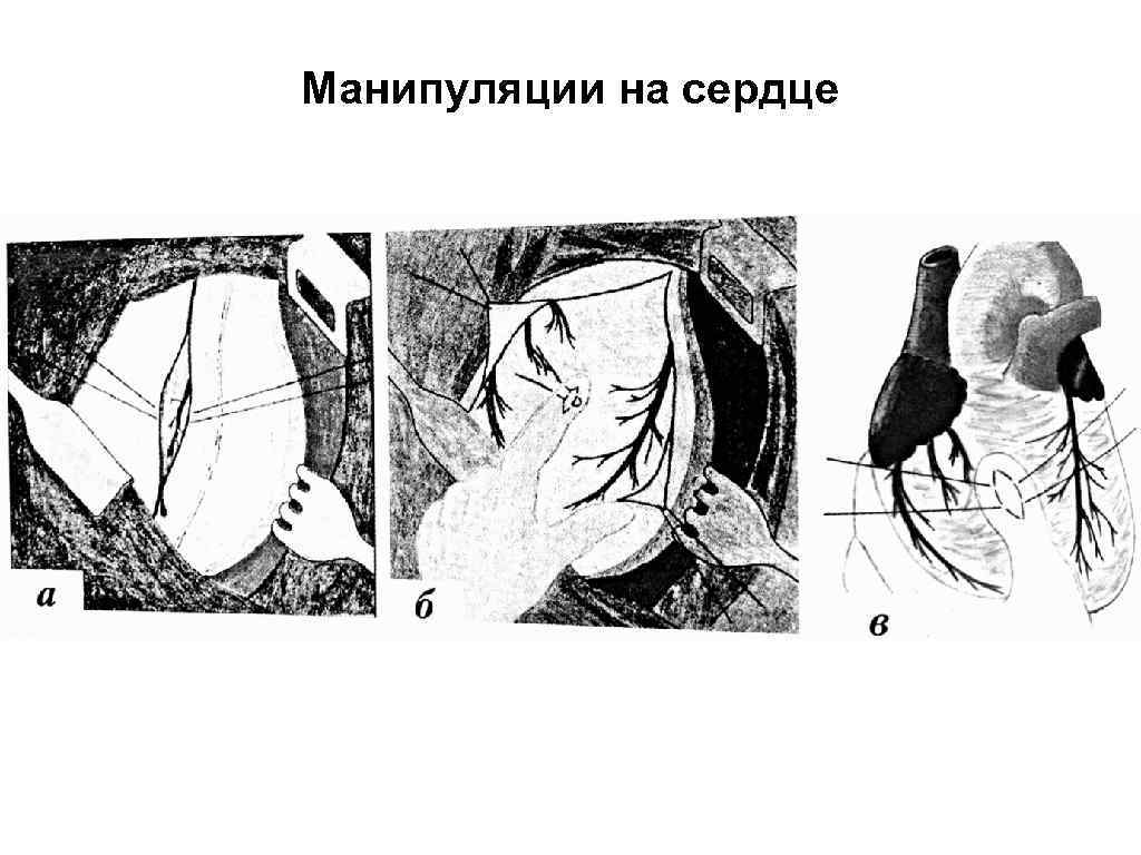 Манипуляции на сердце 
