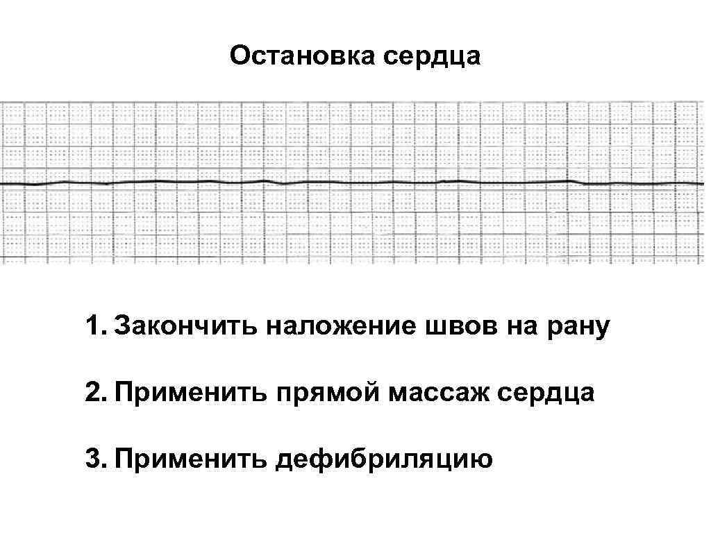 Остановка сердца 1. Закончить наложение швов на рану 2. Применить прямой массаж сердца 3.