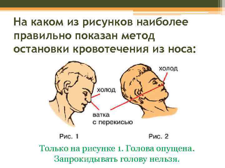 На каком из рисунков наиболее правильно показан метод остановки кровотечения из носа: Только на