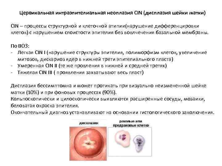 Цервикальная интраэпителиальная неоплазия CIN (дисплазия шейки матки) CIN – процессы структурной и клеточной атипии(нарушение