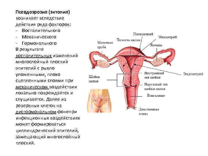 Псевдоэрозия (эктопия) возникает вследствие действия ряда факторов: - Воспалительного - Механического - Гормонального В