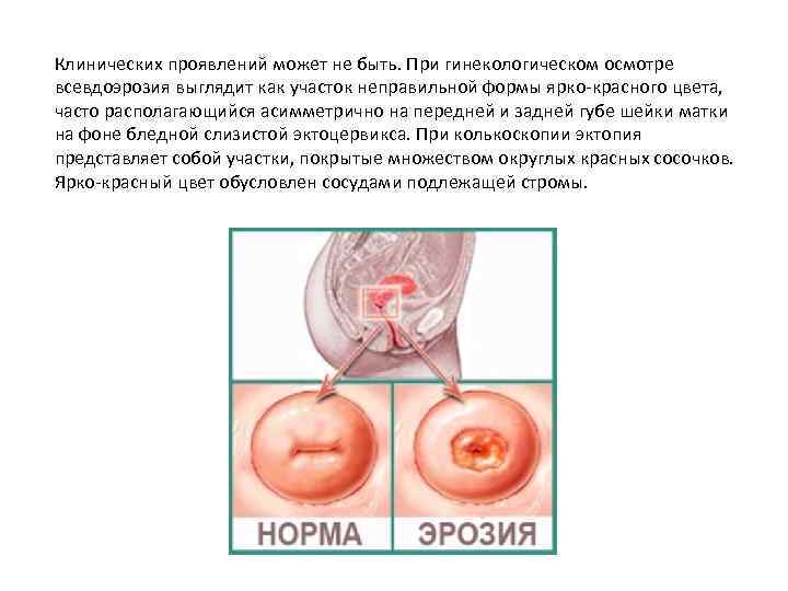 Клинических проявлений может не быть. При гинекологическом осмотре всевдоэрозия выглядит как участок неправильной формы