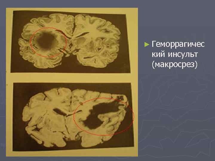 ► Геморрагичес кий инсульт (макросрез) 