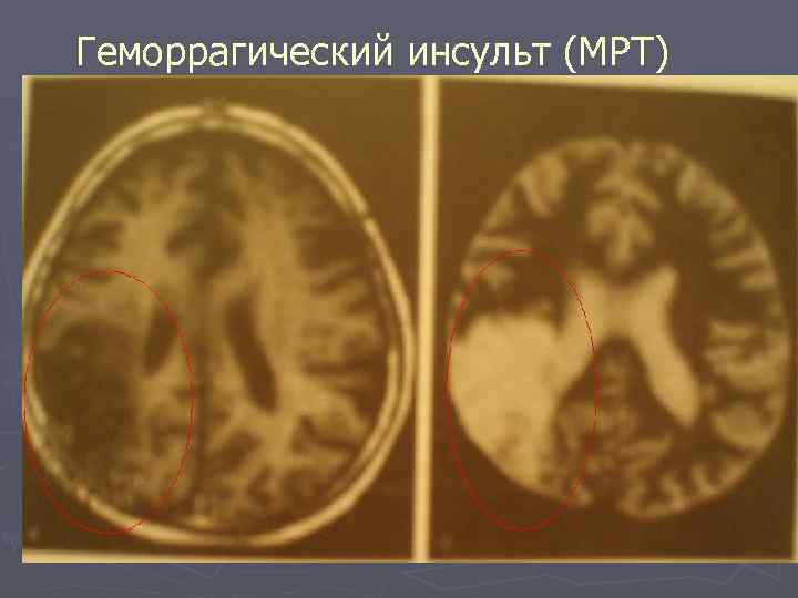 Геморрагический инсульт (МРТ) 