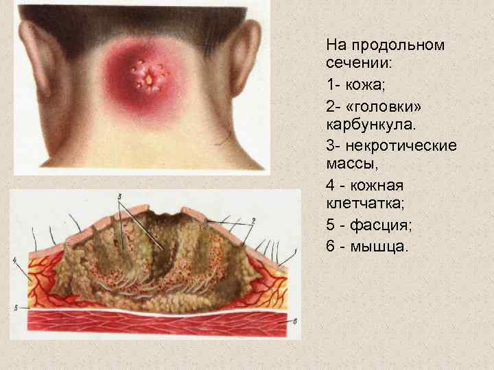 На продольном сечении: 1 - кожа; 2 - «головки» карбункула. 3 - некротические массы,