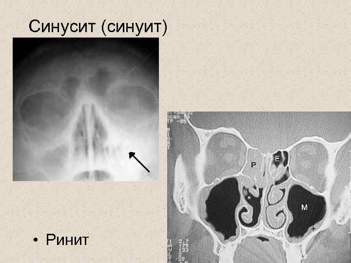 Синусит (синуит) • Ринит 