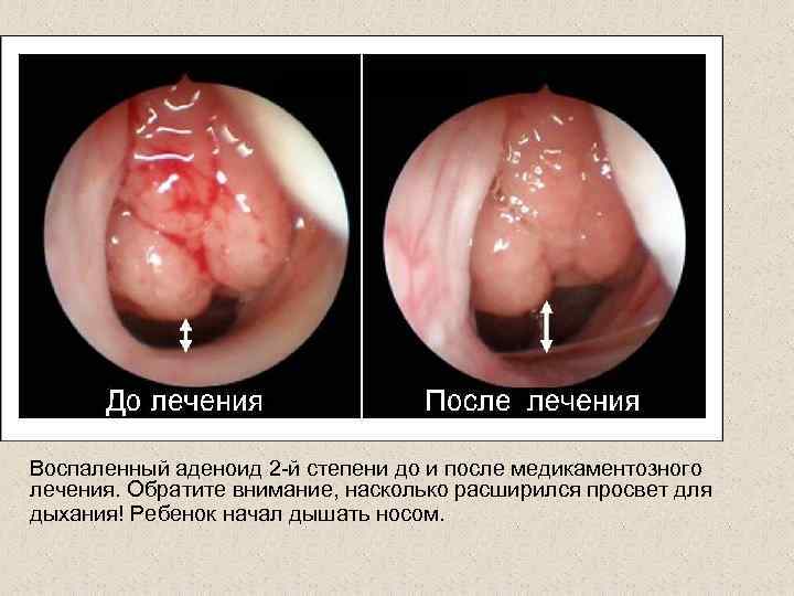 Воспаленный аденоид 2 -й степени до и после медикаментозного лечения. Обратите внимание, насколько расширился