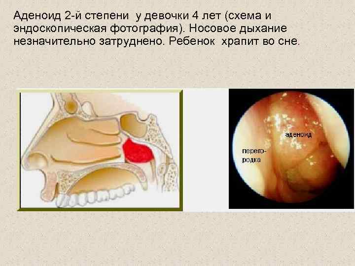 Аденоид 2 -й степени у девочки 4 лет (схема и эндоскопическая фотография). Носовое дыхание