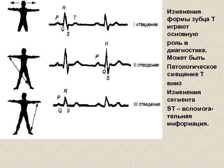 Отрицательный зубец т на экг. Двухфазный зубец т на ЭКГ. Двухфазный зубец т в v5-v6. Двухфазный т в грудных отведениях.