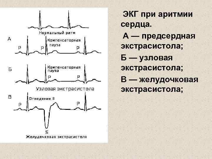 Нарушения на экг. ЭКГ расшифровка нарушение ритма. ЭКГ критерии аритмического синдрома. Аритмии на ЭКГ расшифровка. Аритмия показатели на ЭКГ.