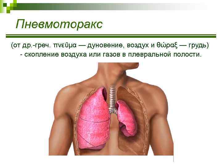 Пневмоторакс (от др. -греч. πνεῦμα — дуновение, воздух и θώραξ — грудь) - скопление
