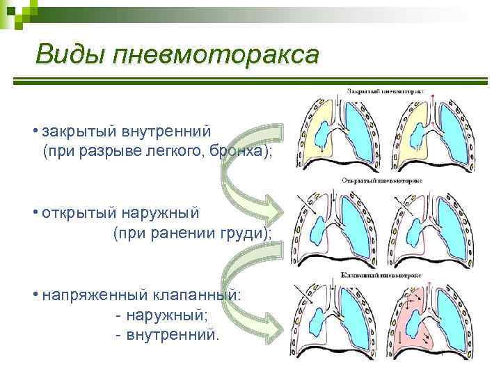 Виды пневмоторакса • закрытый внутренний (при разрыве легкого, бронха); • открытый наружный (при ранении