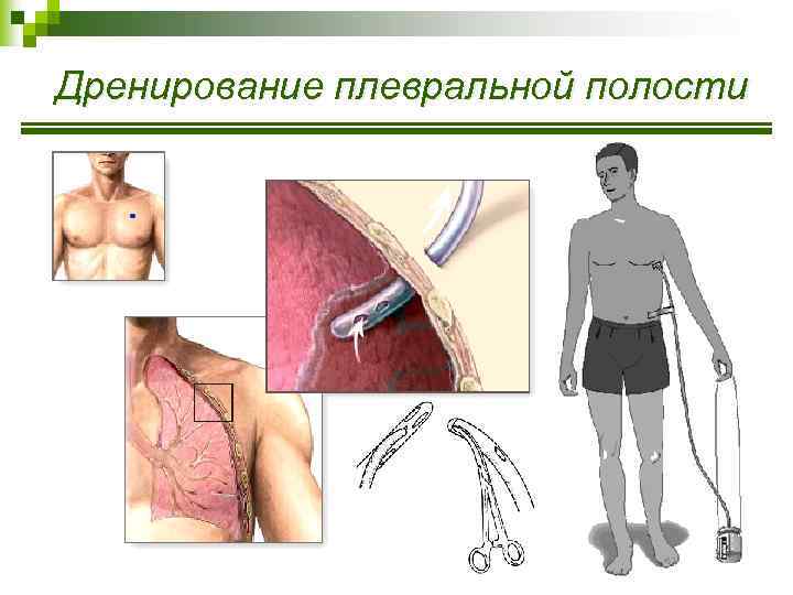Дренирование плевральной полости 
