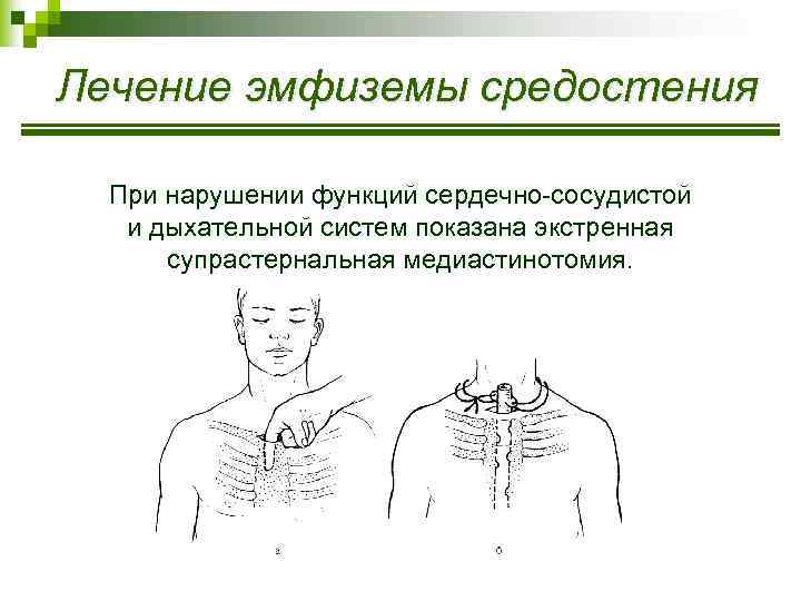 Лечение эмфиземы средостения При нарушении функций сердечно-сосудистой и дыхательной систем показана экстренная супрастернальная медиастинотомия.