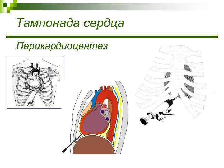 Тампонада сердца Перикардиоцентез 