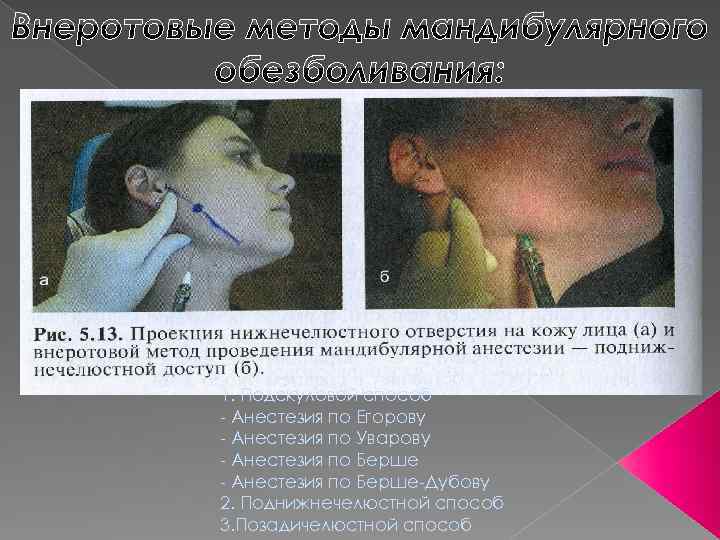 1. Подскуловой способ - Анестезия по Егорову - Анестезия по Уварову - Анестезия по