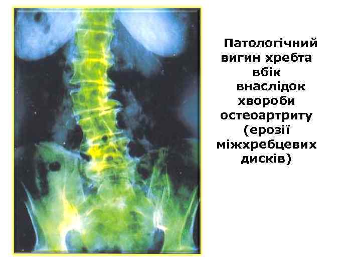 Патологічний вигин хребта вбік внаслідок хвороби остеоартриту (ерозії міжхребцевих дисків) 