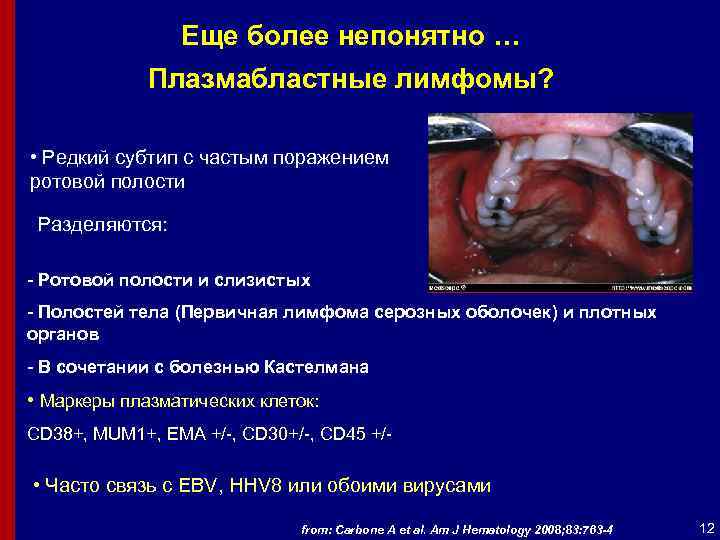 Еще более непонятно … Плазмабластные лимфомы? • Редкий субтип с частым поражением ротовой полости