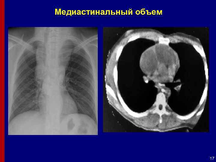 Медиастинальный объем 17 