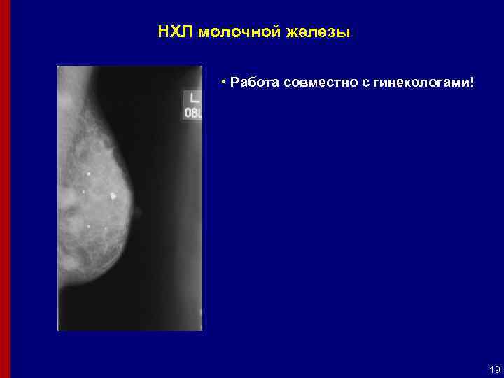 НХЛ молочной железы • Работа совместно с гинекологами! 19 