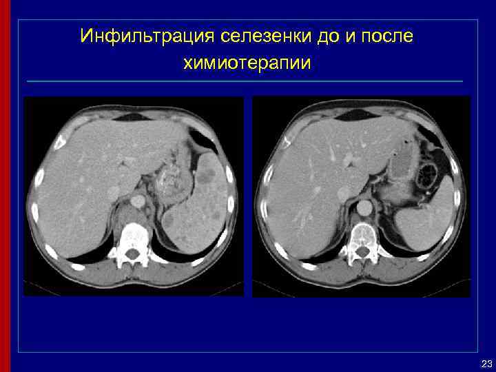 Инфильтрация селезенки до и после химиотерапии 23 