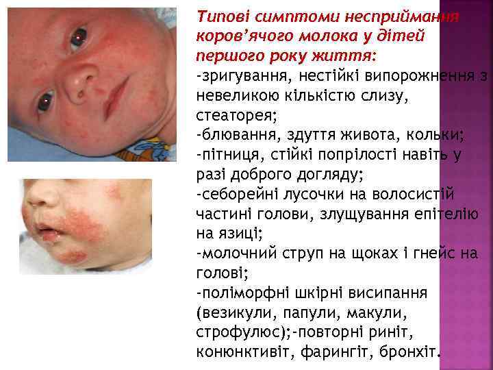Типові симптоми несприймання коров’ячого молока у дітей першого року життя: -зригування, нестійкі випорожнення з