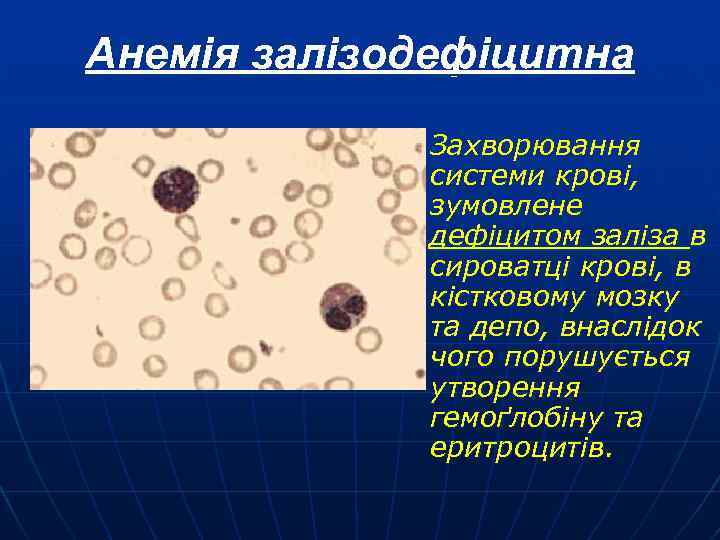 Анемія залізодефіцитна n Захворювання системи крові, зумовлене дефіцитом заліза в сироватці крові, в кістковому