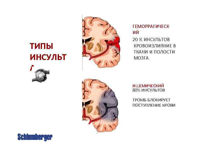 ТИПЫ ИНСУЛЬТ А ГЕМОРРАГИЧЕСК ИЙ 20 % ИНСУЛЬТОВ КРОВОИЗЛИЯНИЕ В ТКАНИ И ПОЛОСТИ МОЗГА