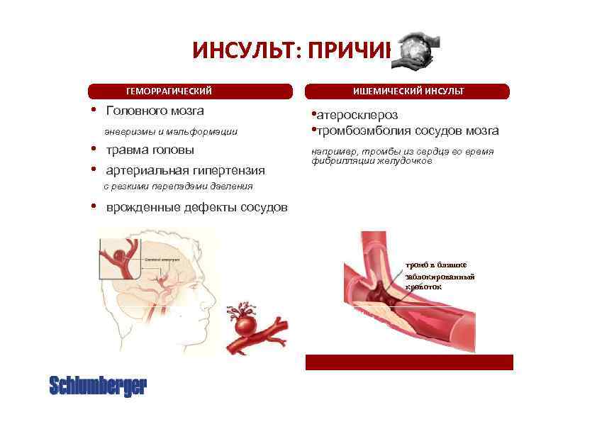 Ишемический инсульт и геморрагический инсульт картинки