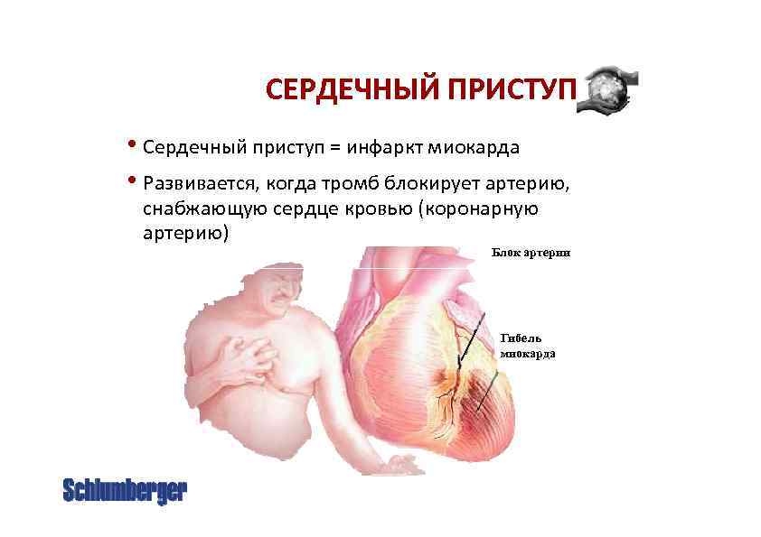 СЕРДЕЧНЫЙ ПРИСТУП • Сердечный приступ = инфаркт миокарда • Развивается, когда тромб блокирует артерию,