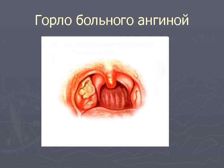 Горло больного ангиной 