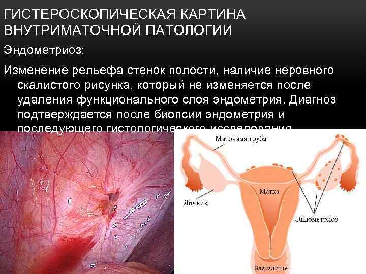 ГИСТЕРОСКОПИЧЕСКАЯ КАРТИНА ВНУТРИМАТОЧНОЙ ПАТОЛОГИИ Эндометриоз: Изменение рельефа стенок полости, наличие неровного скалистого рисунка, который