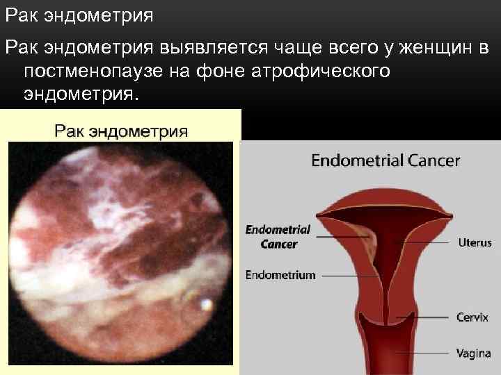 Рак эндометрия выявляется чаще всего у женщин в постменопаузе на фоне атрофического эндометрия. 