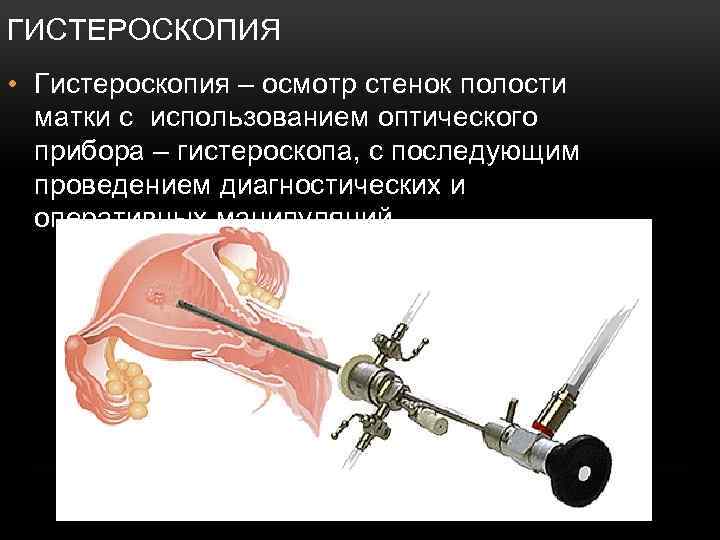 ГИСТЕРОСКОПИЯ • Гистероскопия – осмотр стенок полости матки с использованием оптического прибора – гистероскопа,