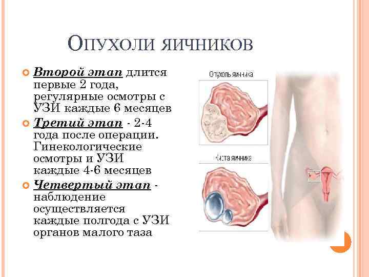  ОПУХОЛИ ЯИЧНИКОВ Второй этап длится первые 2 года, регулярные осмотры с УЗИ каждые