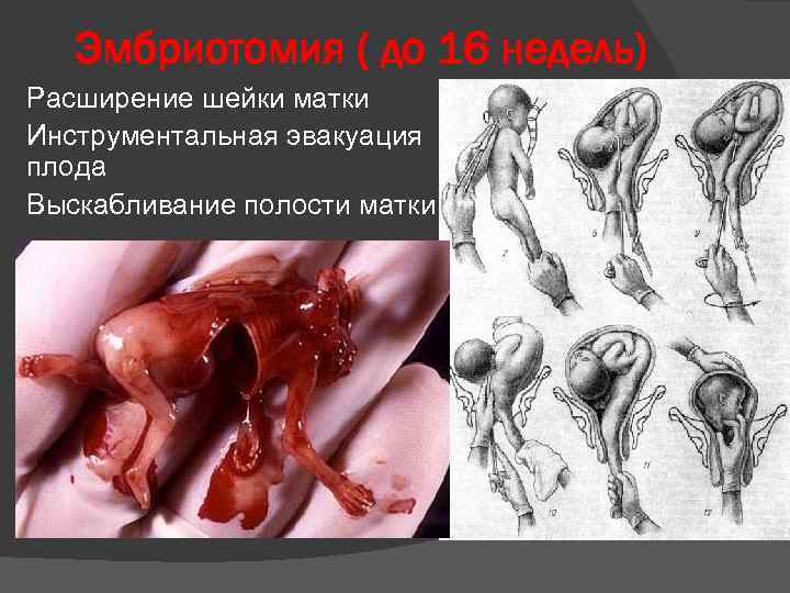Эмбриотомия ( до 16 недель) Расширение шейки матки Инструментальная эвакуация плода Выскабливание полости матки