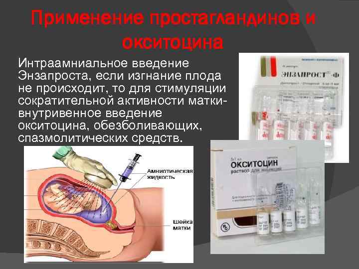 Применение простагландинов и окситоцина Интраамниальное введение Энзапроста, если изгнание плода не происходит, то для