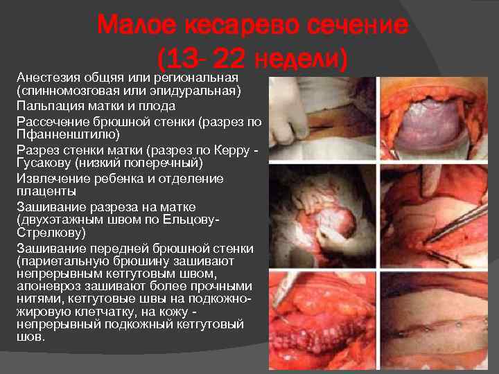 Малое кесарево сечение (13 - 22 недели) Анестезия общяя или региональная (спинномозговая или эпидуральная)