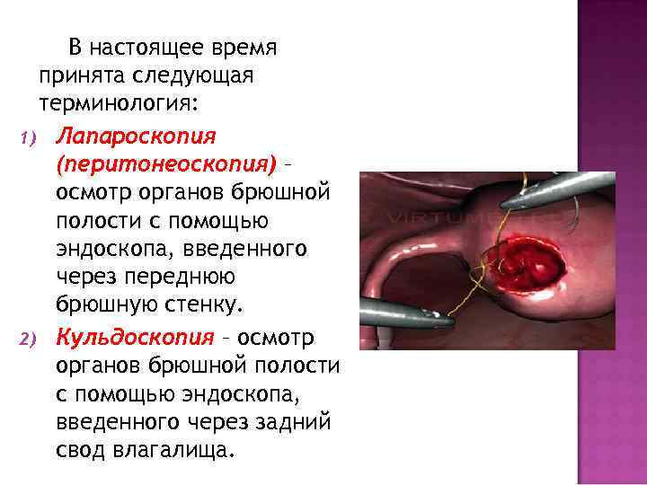 В настоящее время принята следующая терминология: 1) Лапароскопия (перитонеоскопия) – осмотр органов брюшной полости